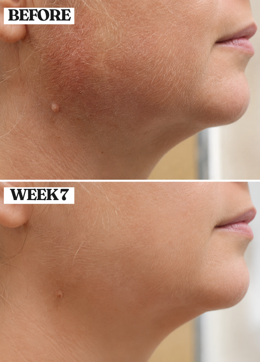Norya Cyperus Rotundus Serum